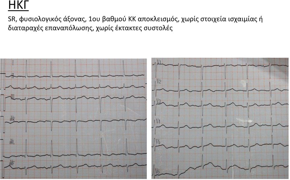 στοιχεία ισχαιμίας ή διαταραχές