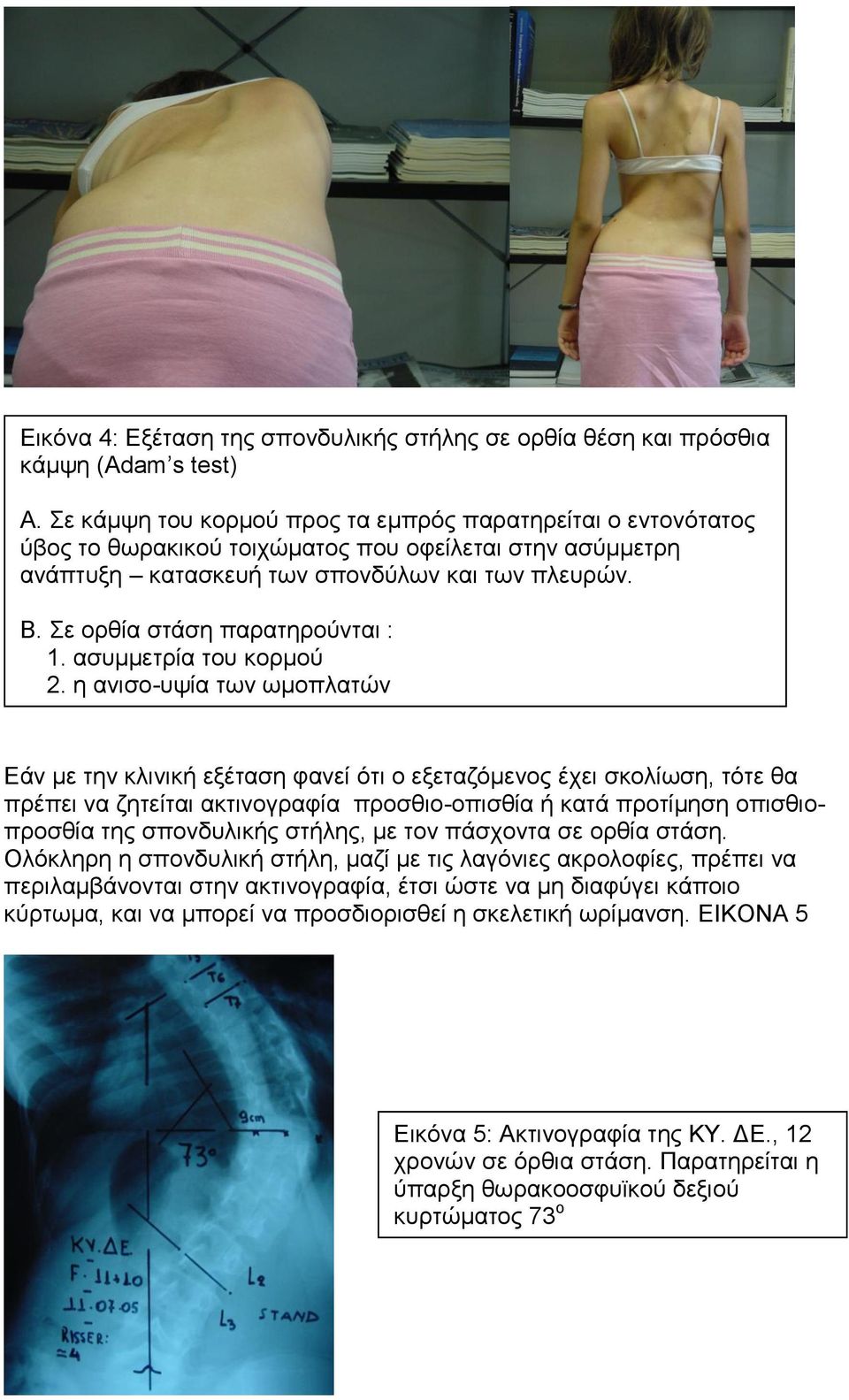 Σε ορθία στάση παρατηρούνται : 1. ασυμμετρία του κορμού 2.