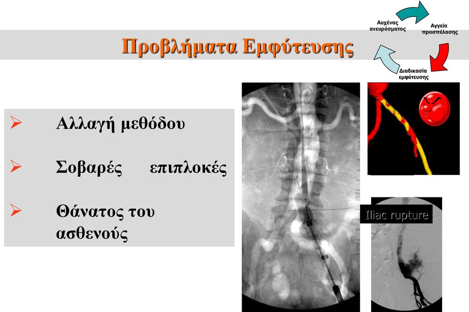 Διαδικασία εμφύτευσης Αλλαγή μεθόδου