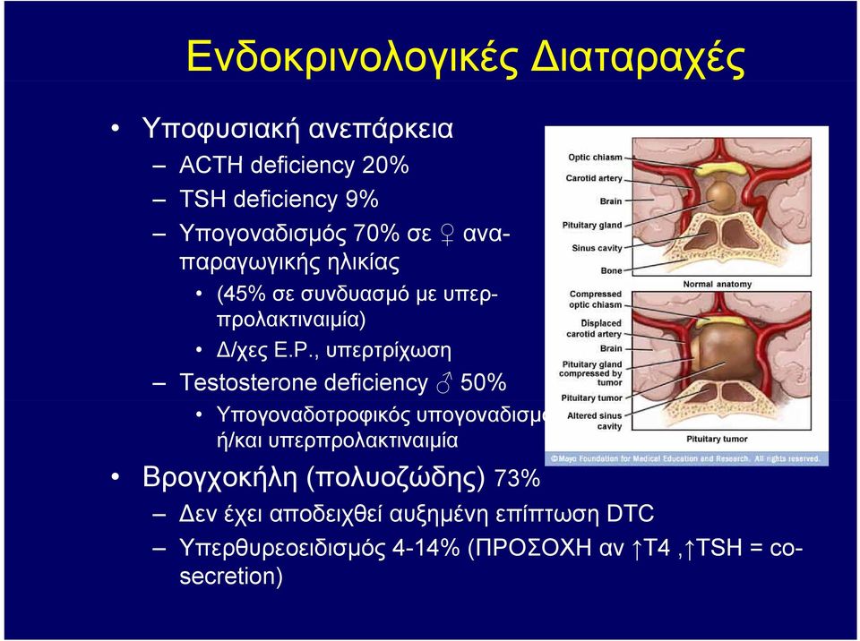 , υπερτρίχωση Testosterone deficiency 50% Υπογοναδοτροφικός υπογοναδισμός ή/και υπερπρολακτιναιμία