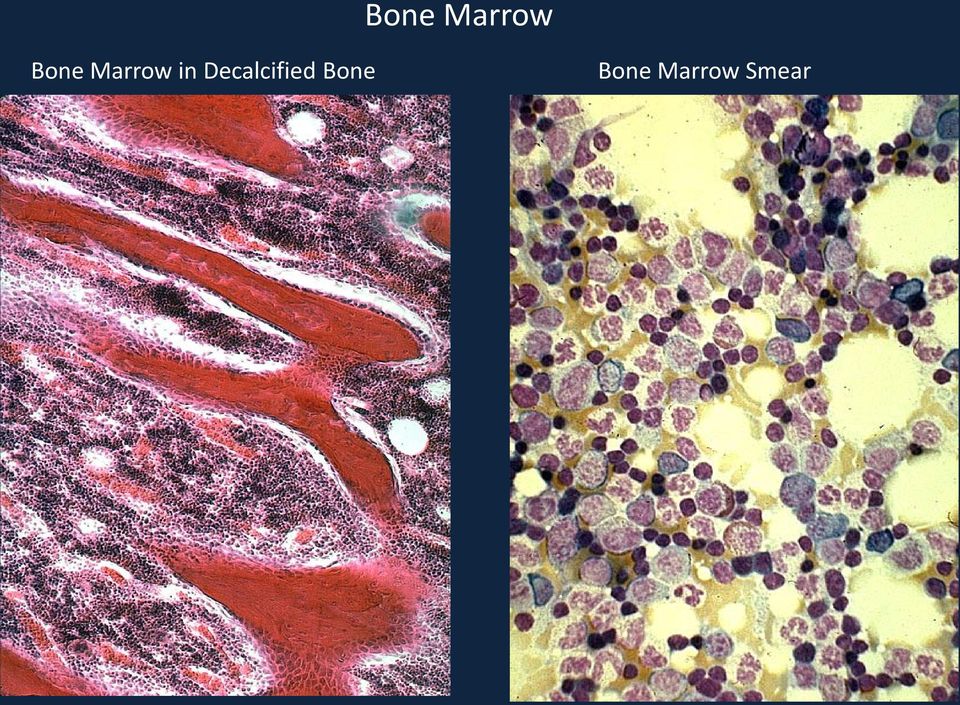 Bone  Smear