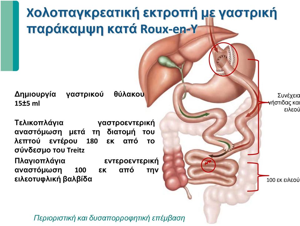 180 εκ από το σύνδεσμο του Treitz Πλαγιοπλάγια εντεροεντερική αναστόμωση 100 εκ από την