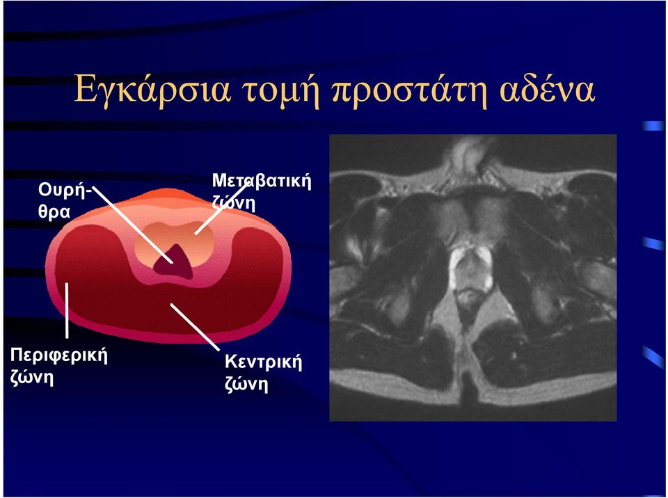 Ουρήθρα Μεταβατική