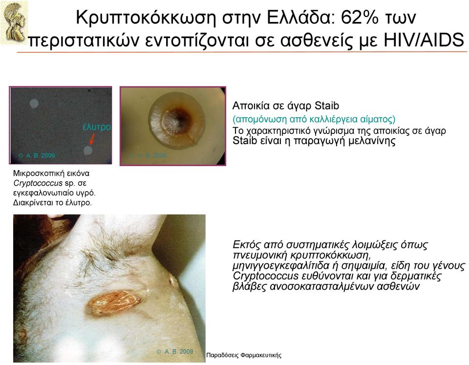 Β 2009 Μικροσκοπική εικόνα Cryptococcus sp. σε εγκεφαλονωτιαίο υγρό. Διακρίνεται το έλυτρο.