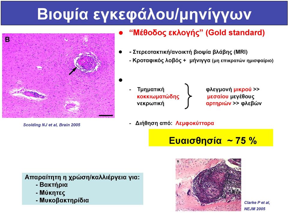 µεγέθους νεκρωτική αρτηριών >> φλεβών Scolding NJ et al, Brain 2005 - Διήθηση από: Λεµφοκύτταρα