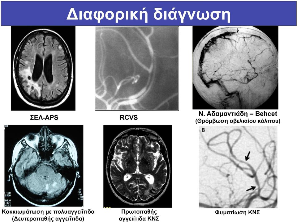 κόλπου) Κοκκιωµάτωση µε πολυαγγειΐτιδα