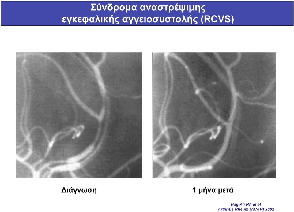 (RCVS) Διάγνωση 1 µήνα µετά