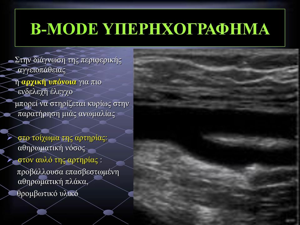 παρατήρηση µιάς ανωµαλίας στο τοίχωµα της αρτηρίας: αθηρωµατική νόσος