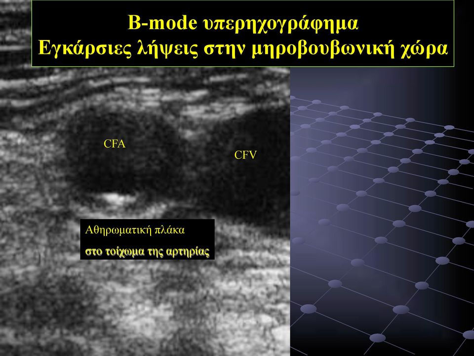 µηροβουβωνική χώρα CFA CFV