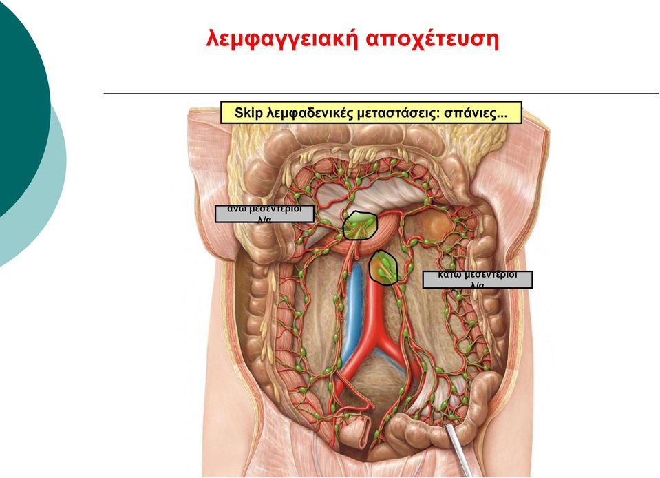 μεταστάσεις: σπάνιες.