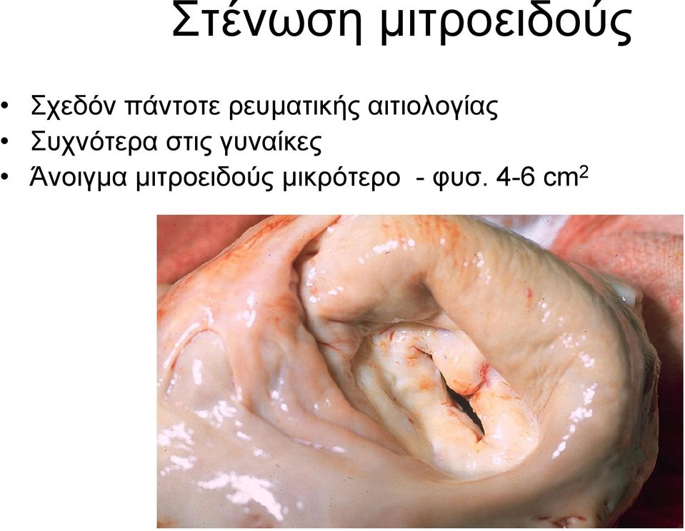 Συχνότερα στις γυναίκες Άνοιγµα