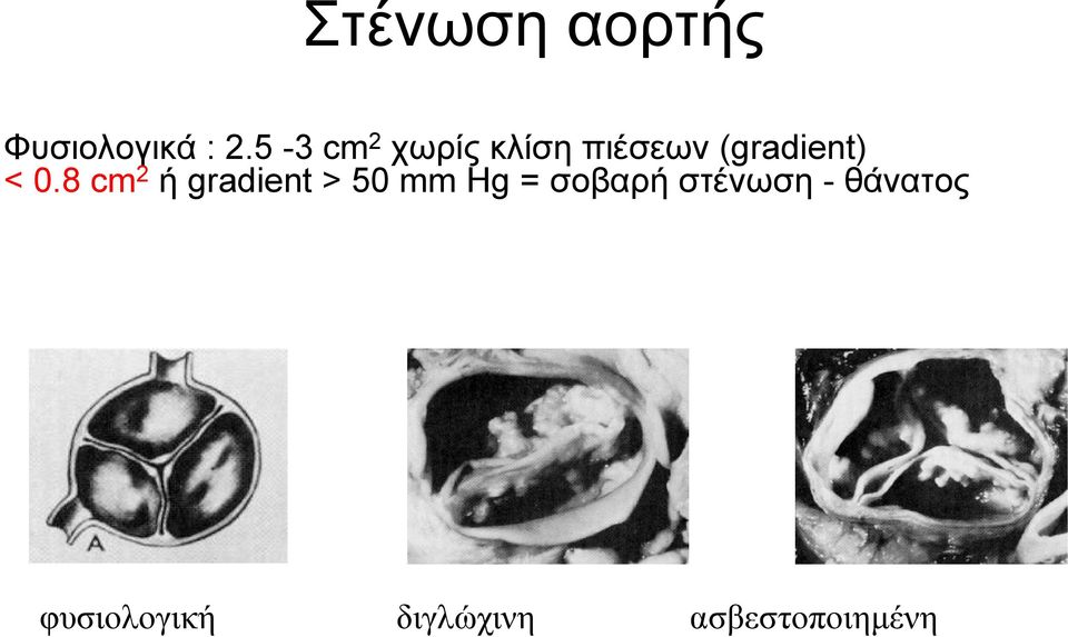 <0.8 cm 2 ή gradient > 50 mm Hg = σοβαρή