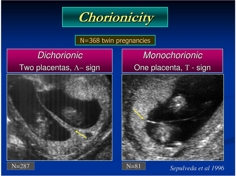 placentas, Λ sign Monochorionic