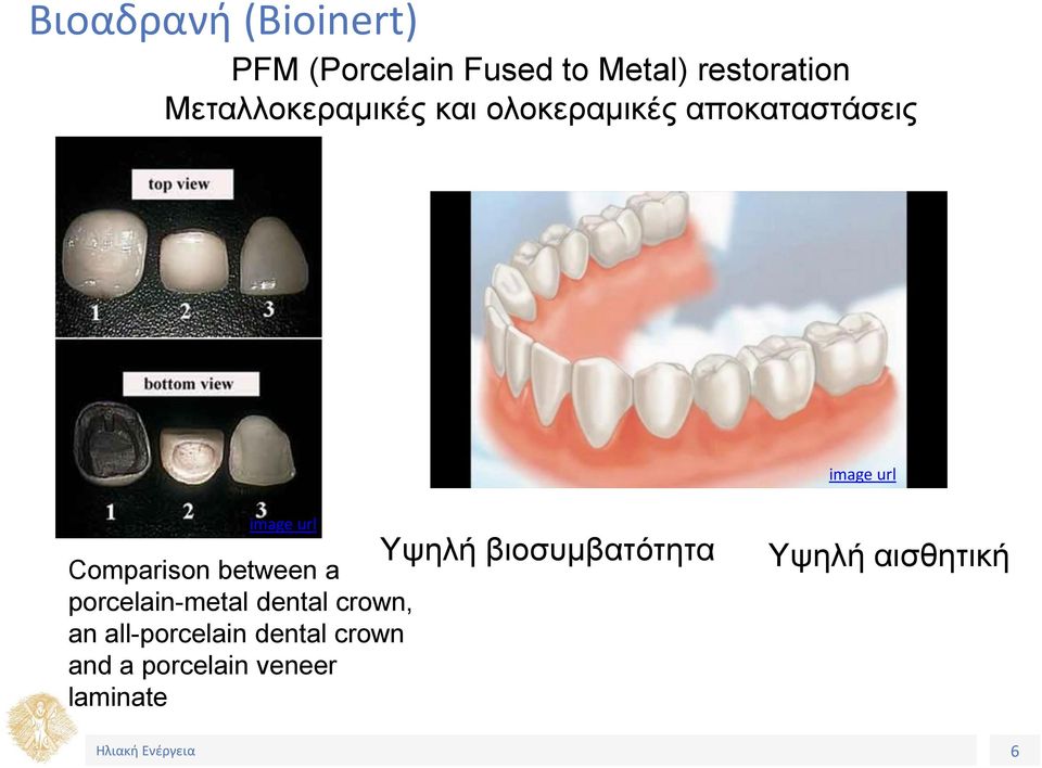 Comparison between a porcelain-metal dental crown, an all-porcelain