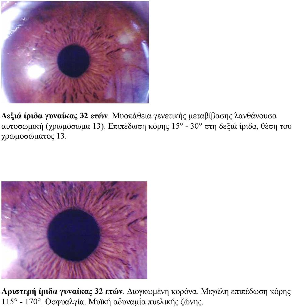 Επιπέδωση κόρης 15-30 στη δεξιά ίριδα, θέση του χρωμοσώματος 13.