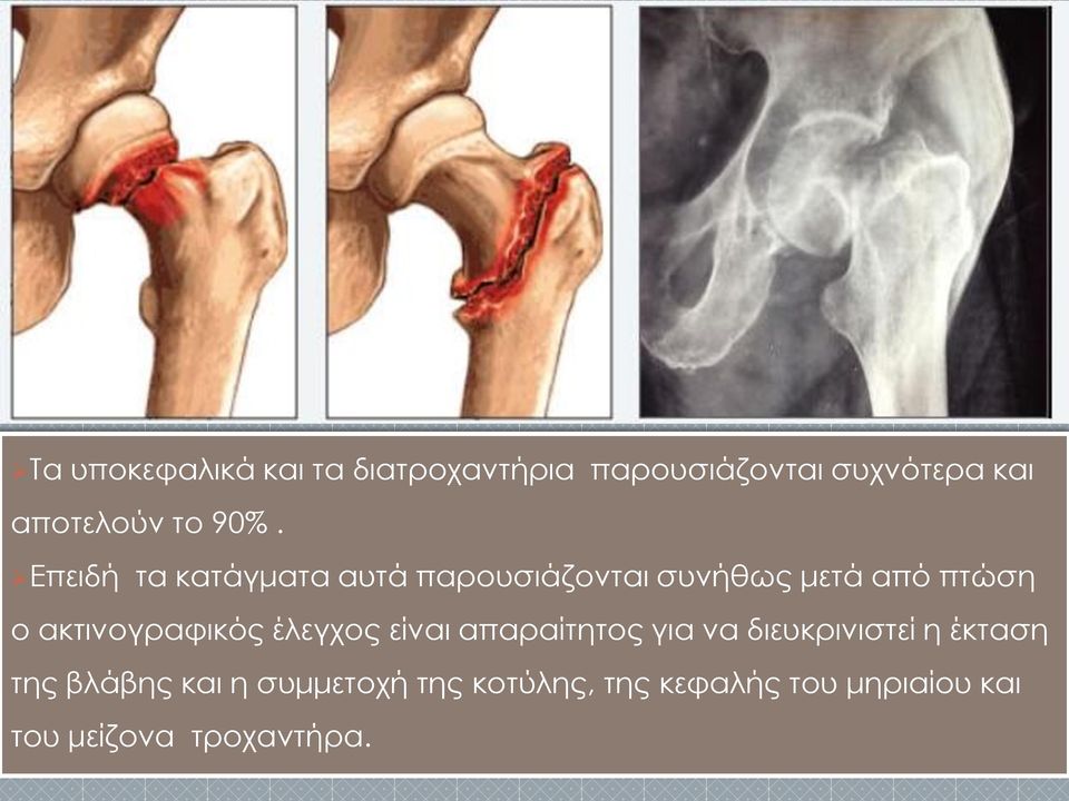 Επειδή τα κατάγματα αυτά παρουσιάζονται συνήθως μετά από πτώση ο