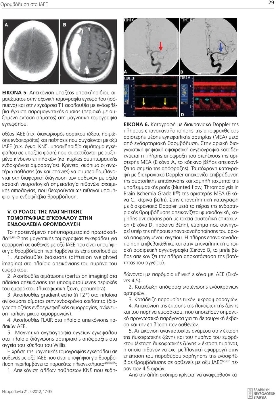 σήματος) στη μαγνητική τομογραφία εγκεφάλου. οξέος ΙΑΕΕ (π.χ.