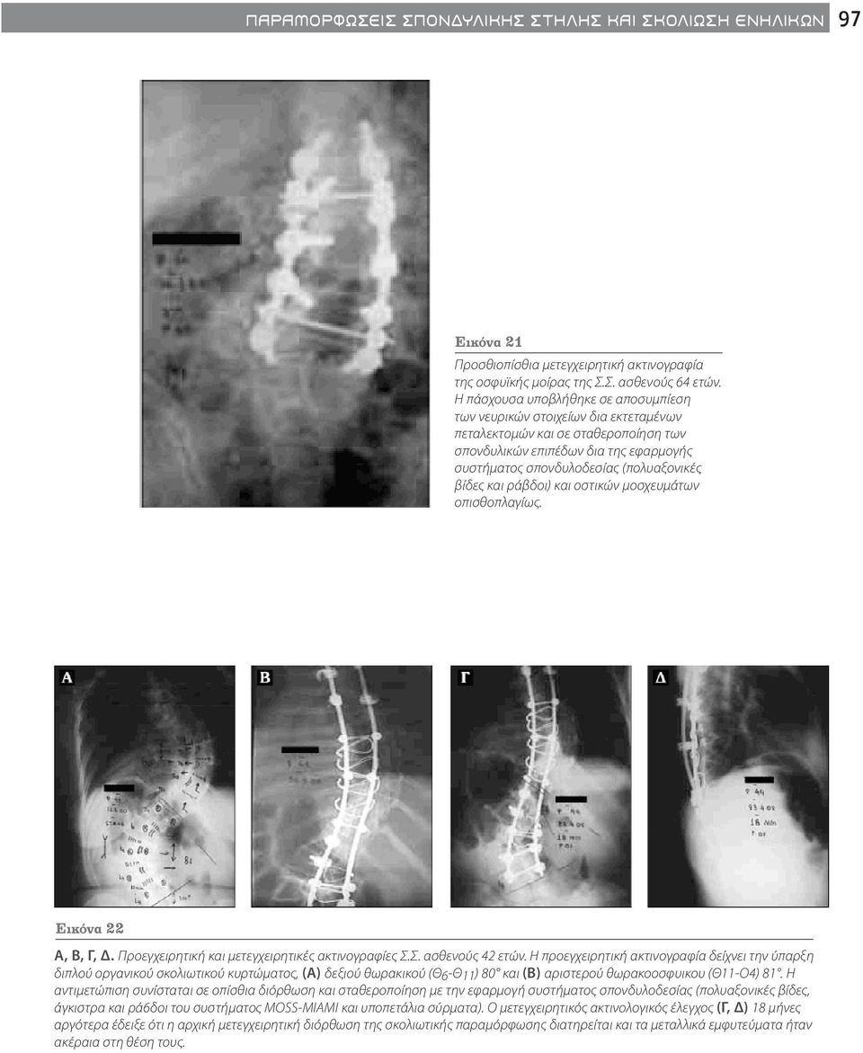 και ράβδοι) και οστικών μοσχευμάτων οπισθοπλαγίως. Εικόνα 22 A, B, Γ, Δ. Προεγχειρητική και μετεγχειρητικές ακτινογραφίες Σ.Σ. ασθενούς 42 ετών.