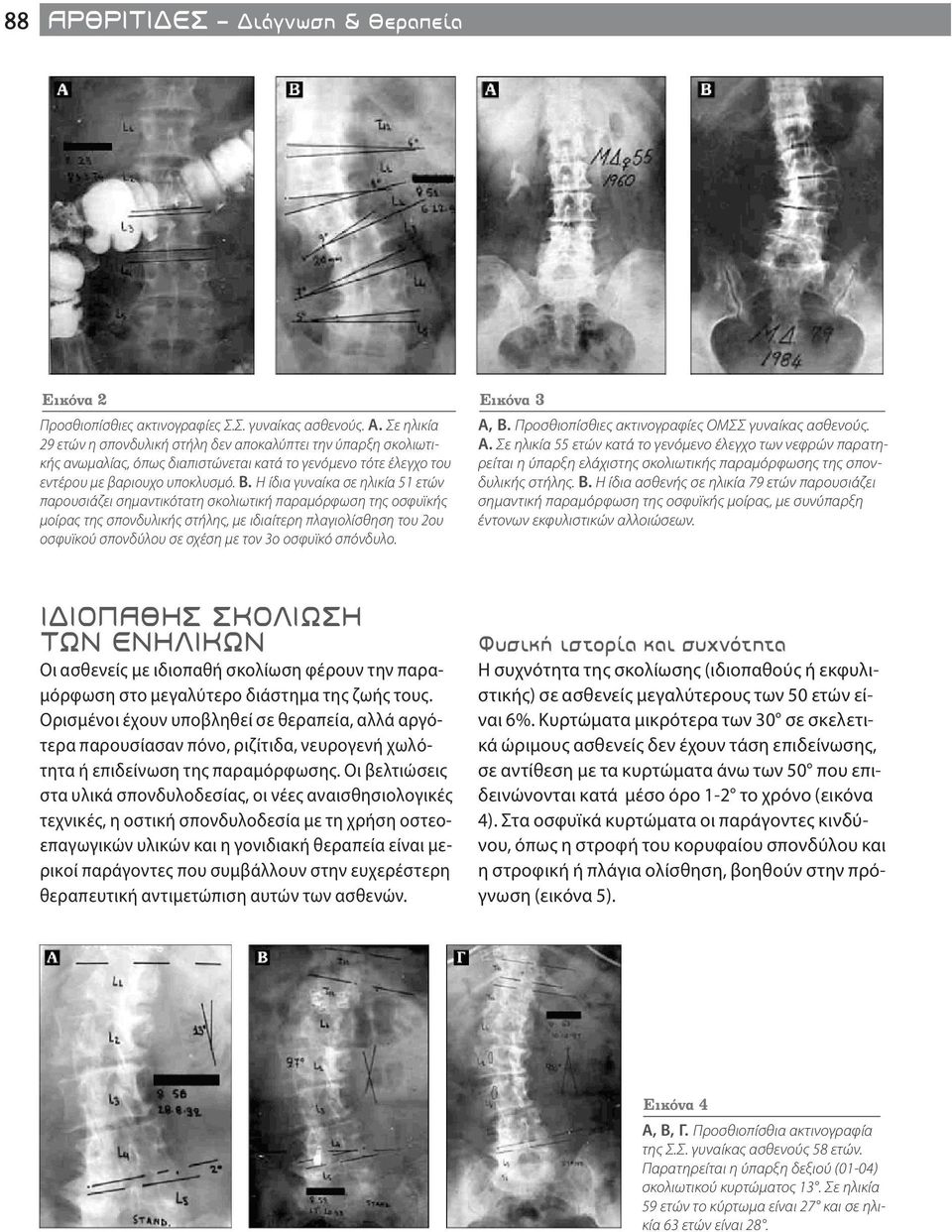 3ο οσφυϊκό σπόνδυλο. Εικόνα 3 Α, Β. Προσθιοπίσθιες ακτινογραφίες ΟΜΣΣ γυναίκας ασθενούς. Α. Σε ηλικία 55 ετών κατά το γενόμενο έλεγχο των νεφρών παρατηρείται η ύπαρξη ελάχιστης σκολιωτικής παραμόρφωσης της σπονδυλικής στήλης.