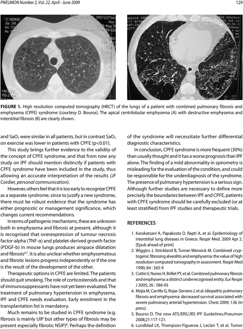 The apical centrilobular emphysema (A) with destructive emphysema and interstitial fibrosis (B) are clearly shown.