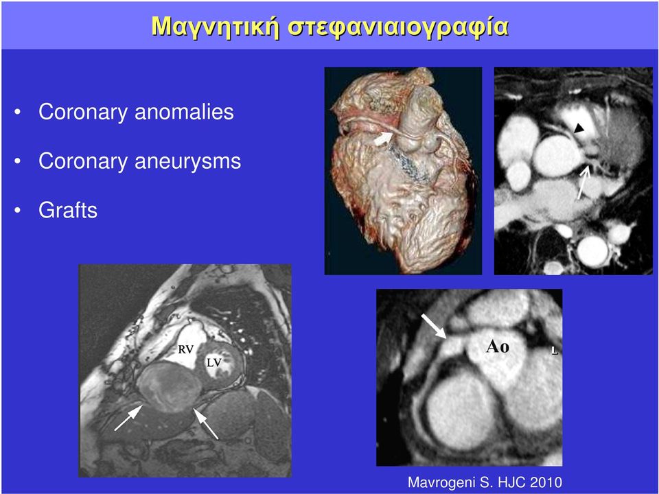 Coronary anomalies
