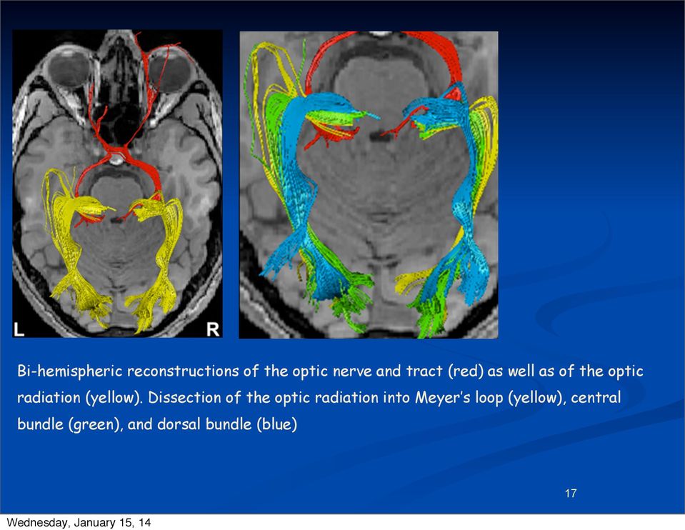 Dissection of the optic radiation into Meyer s loop