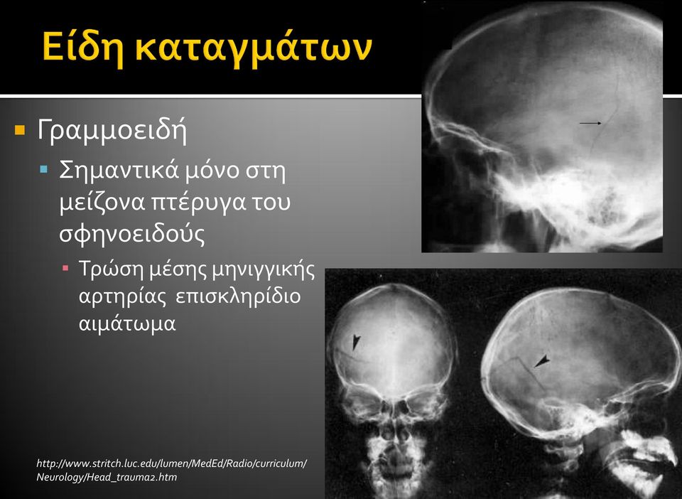 επισκληρίδιο αιμάτωμα http://www.stritch.luc.