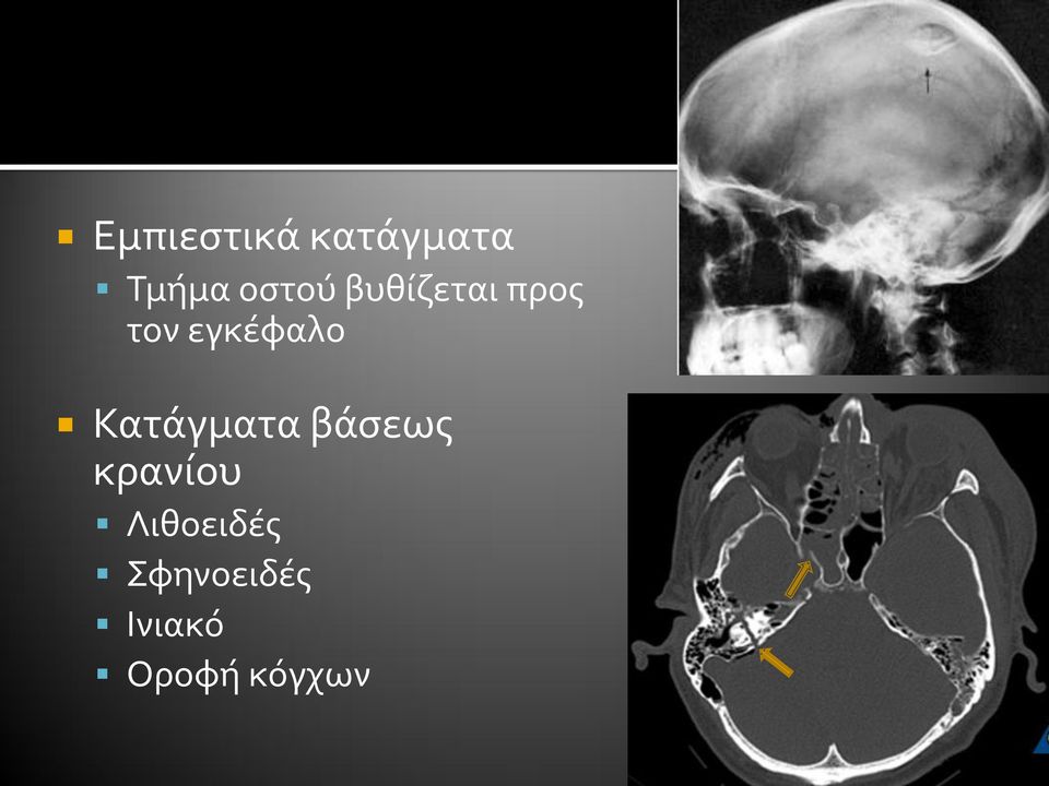 εγκέφαλο Κατάγματα βάσεως