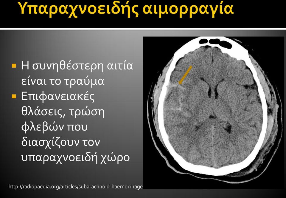 διασχίζουν τον υπαραχνοειδή χώρο