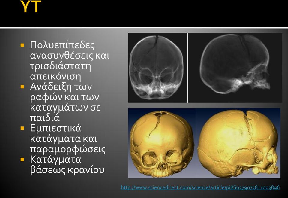 Εμπιεστικά κατάγματα και παραμορφώσεις Κατάγματα βάσεως