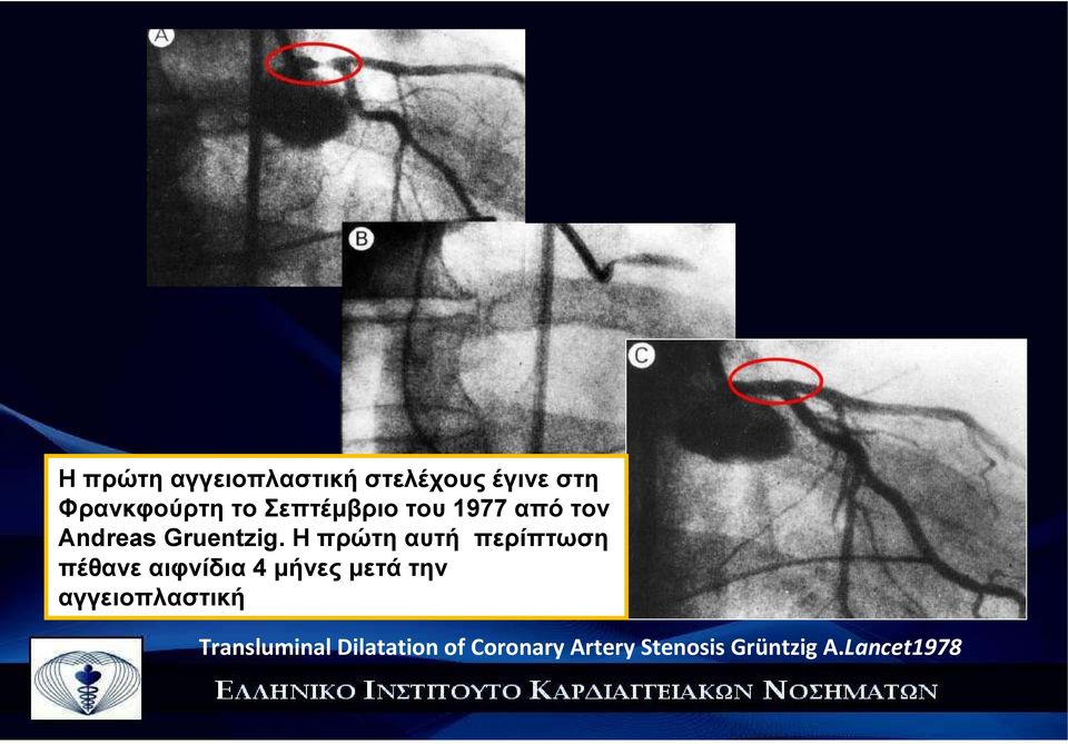 Η πρώτη αυτή περίπτωση πέθανε αιφνίδια 4 µήνες µετά την