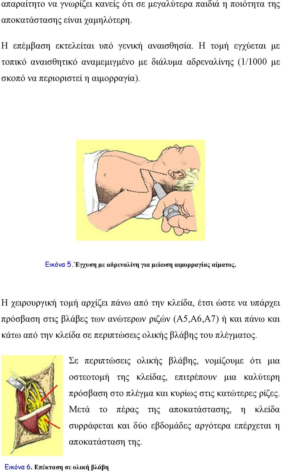 Η χειρουργική τομή αρχίζει πάνω από την κλείδα, έτσι ώστε να υπάρχει πρόσβαση στις βλάβες των ανώτερων ριζών (Α5,Α6,Α7) ή και πάνω και κάτω από την κλείδα σε περιπτώσεις ολικής βλάβης του πλέγματος.