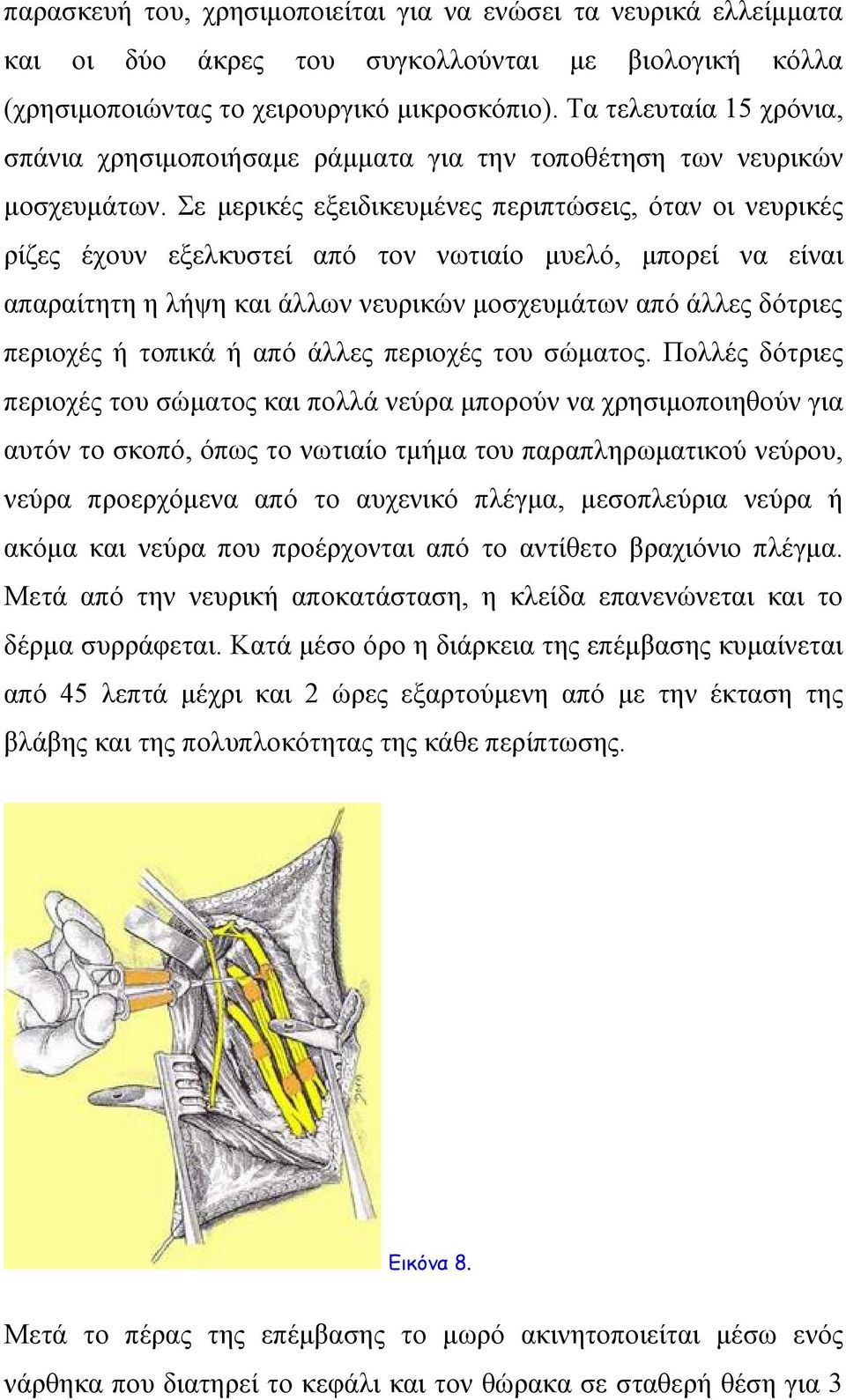 Σε μερικές εξειδικευμένες περιπτώσεις, όταν οι νευρικές ρίζες έχουν εξελκυστεί από τον νωτιαίο μυελό, μπορεί να είναι απαραίτητη η λήψη και άλλων νευρικών μοσχευμάτων από άλλες δότριες περιοχές ή