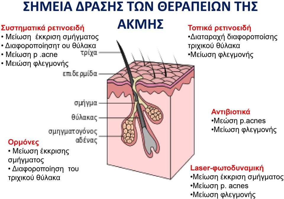 acne Μειώση φλεγμονής ΑΚΜΗΣ Τοπικά ρετινοειδή Διαταραχή διαφοροποίσης τριχικού θύλακα Μείωση