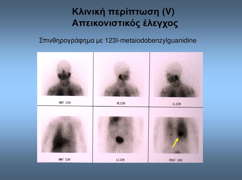 Σπινθηρογράφημα με