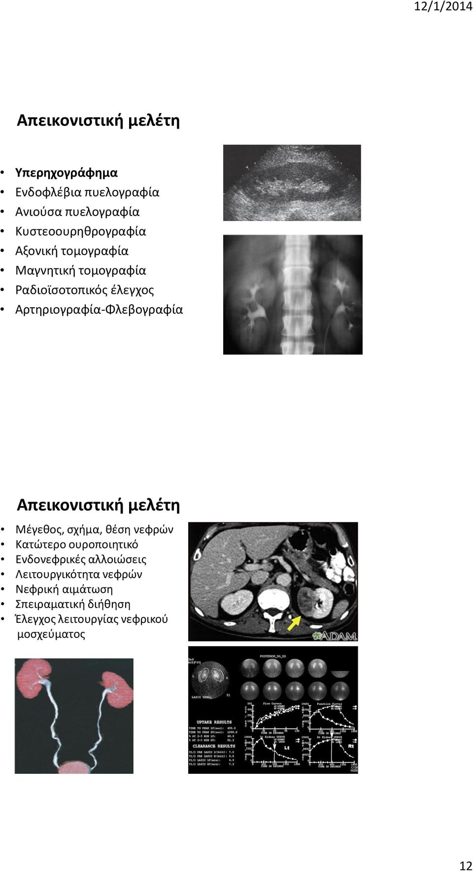 Αρτηριογραφία-Φλεβογραφία Απεικονιστική μελέτη Μέγεθος, σχήμα, θέση νεφρών Κατώτερο ουροποιητικό