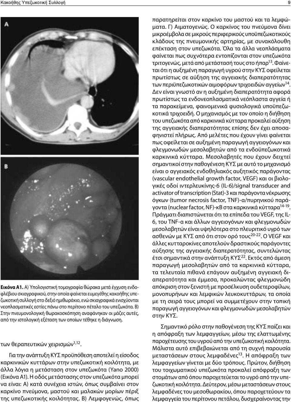 εστίες πάνω στο περίτονο πέταλο του υπεζωκότα. Β) Στην πνευμονολογική θωρακοσκόπηση αναφάνηκαν οι μάζες αυτές, από την ιστολογική εξέταση των οποίων τέθηκε η διάγνωση. των θεραπευτικών χειρισμών 1,12.