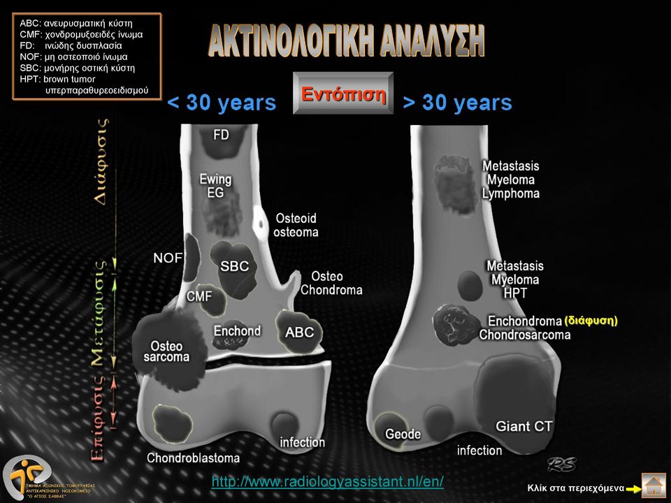 μονήρης οστική κύστη HPT: brown tumor