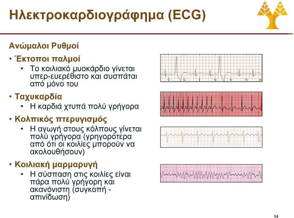 πτερυγισμός Η αγωγή στους κόλπους γίνεται πολύ γρήγορα (γρηγορότερα από ότι οι κοιλίες μπορούν να