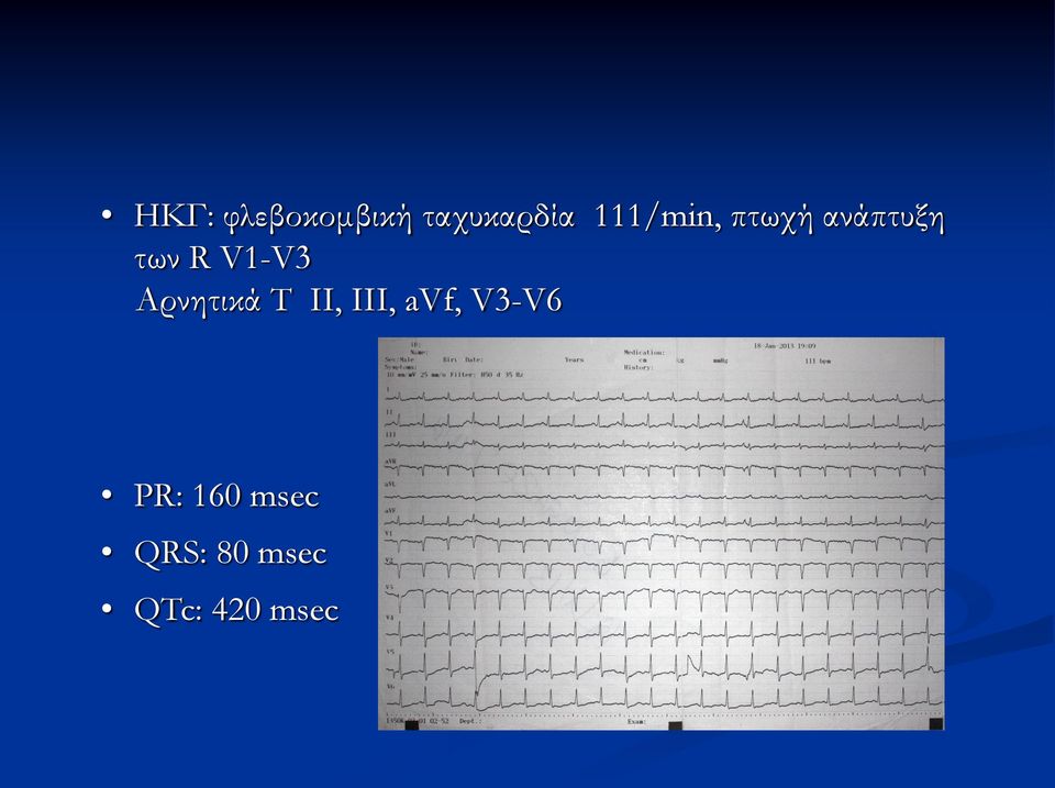 V1-V3 Αρνητικά Τ II, III, avf,