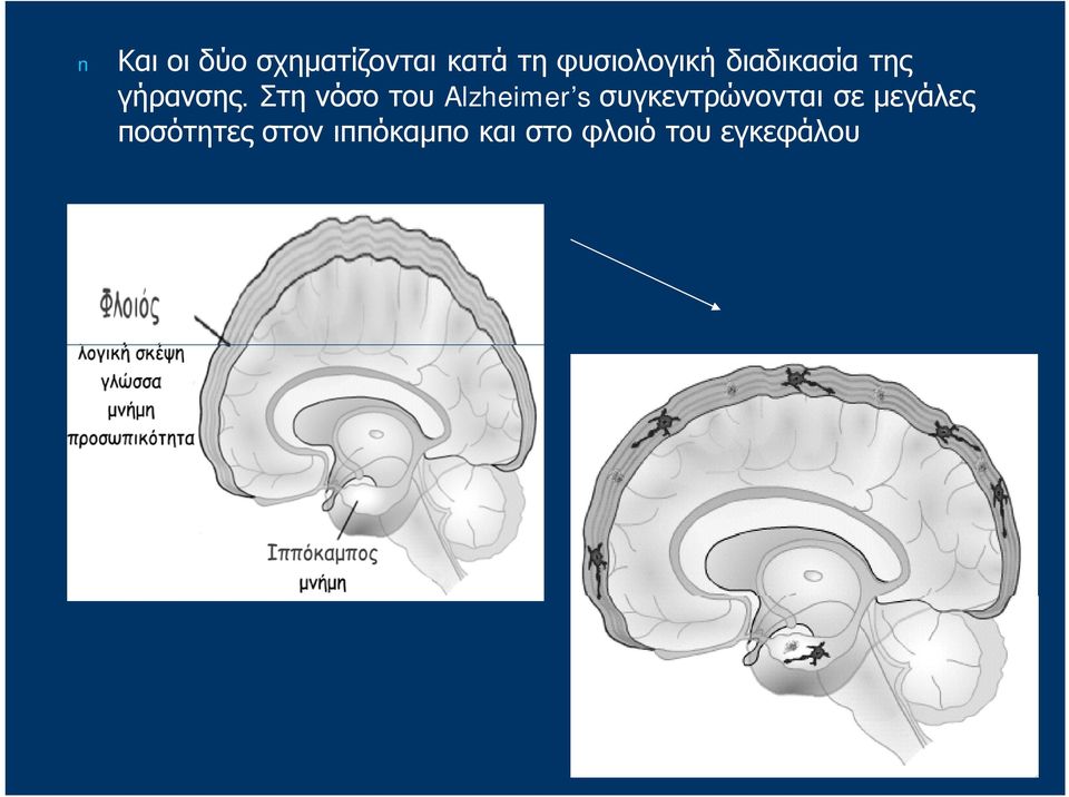 Στη νόσο του Alzheimer s συγκεντρώνονται σε