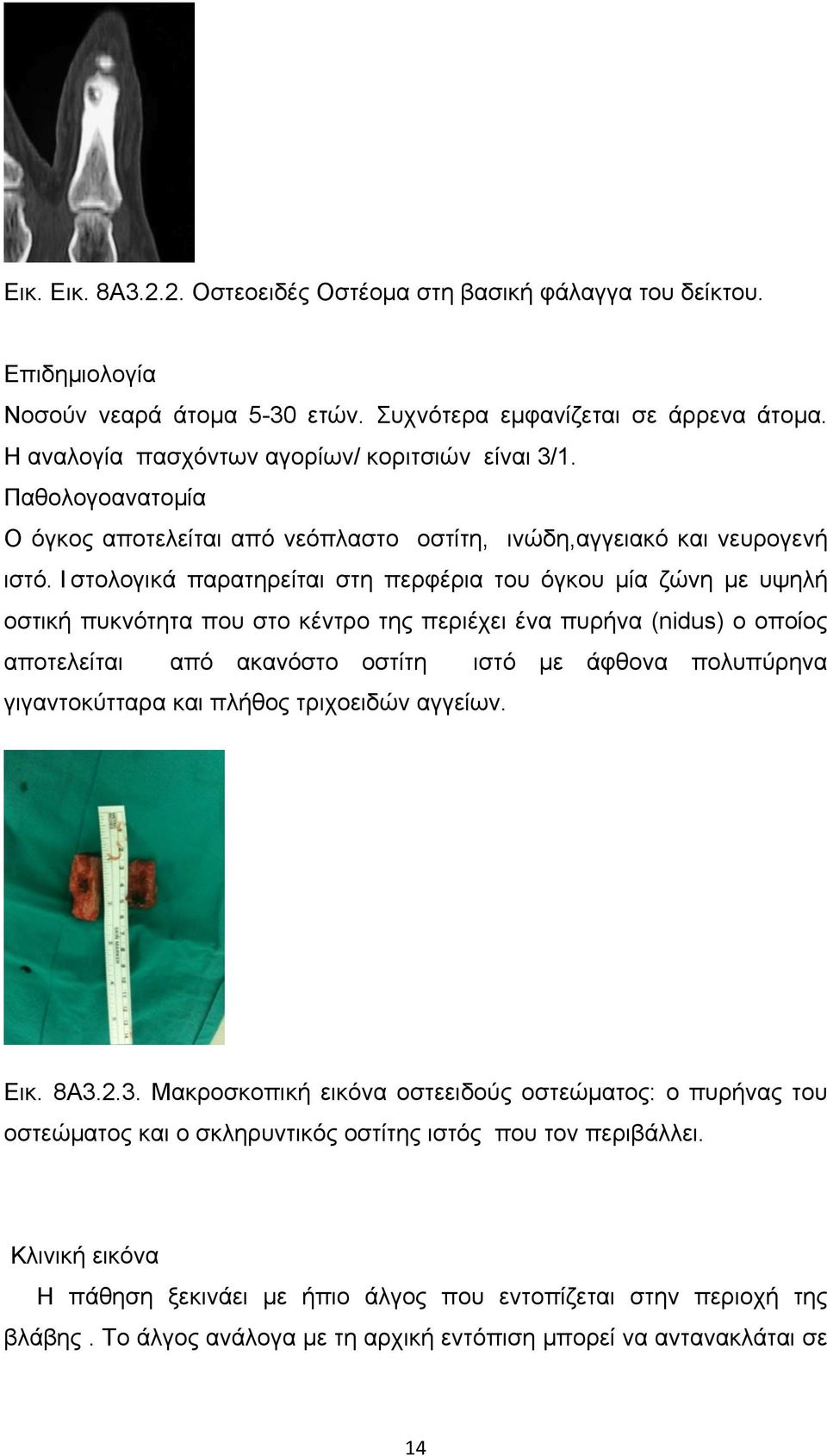 Ι στολογικά παρατηρείται στη περφέρια του όγκου µία ζώνη µε υψηλή οστική πυκνότητα που στο κέντρο της περιέχει ένα πυρήνα (nidus) ο οπoίος αποτελείται από ακανόστο οστίτη ιστό µε άφθονα πολυπύρηνα