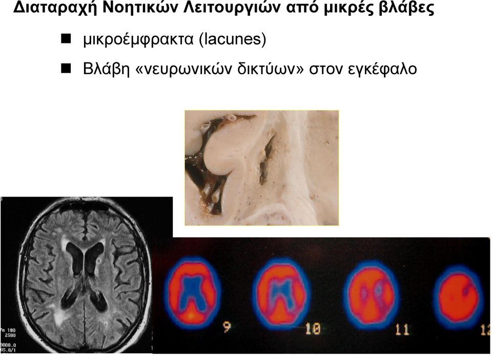 βλάβες μικροέμφρακτα