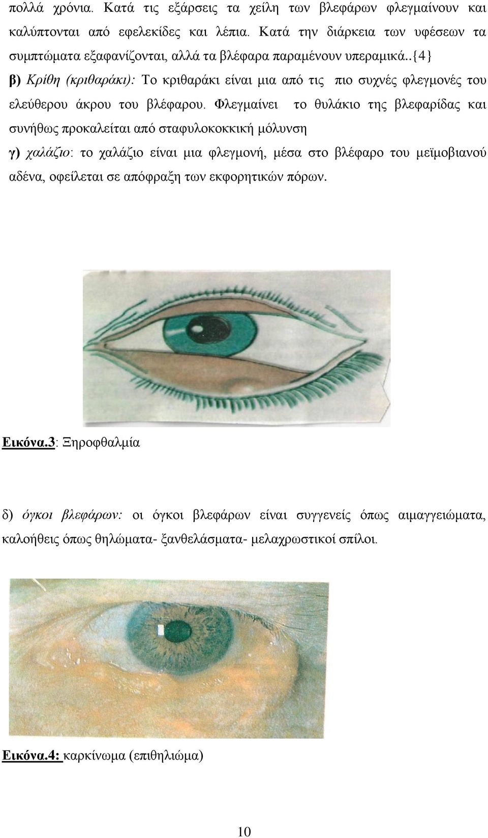 .{4} β) Κρίθη (κριθαράκι): Το κριθαράκι είναι μια από τις πιο συχνές φλεγμονές του ελεύθερου άκρου του βλέφαρου.