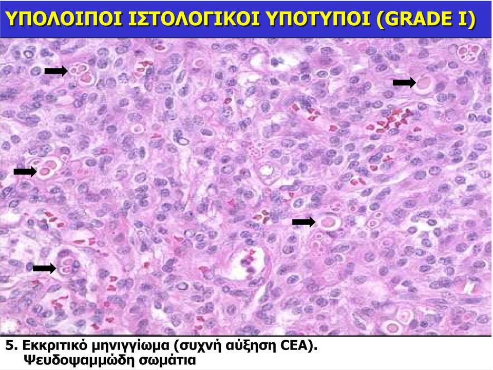 Εκκριτικό µηνιγγίωµα