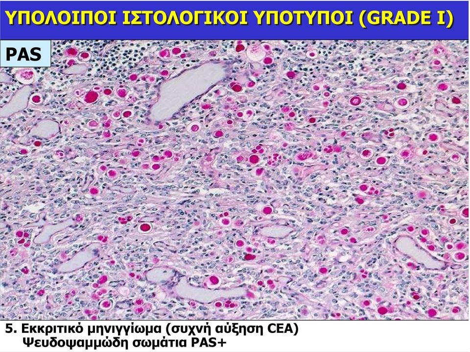 Εκκριτικό µηνιγγίωµα (συχνή