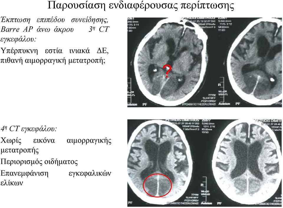 πιθανή αιμορραγική μετατροπή;?