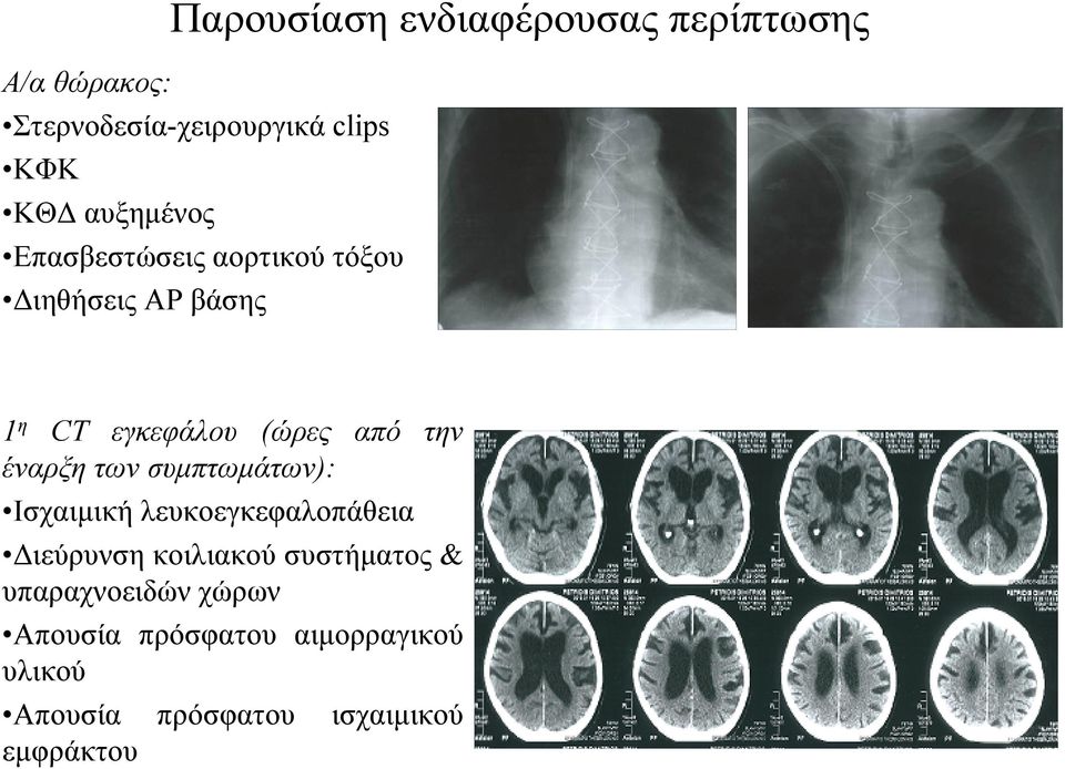 έναρξη των συμπτωμάτων): Ισχαιμική λευκοεγκεφαλοπάθεια Διεύρυνση κοιλιακού συστήματος &