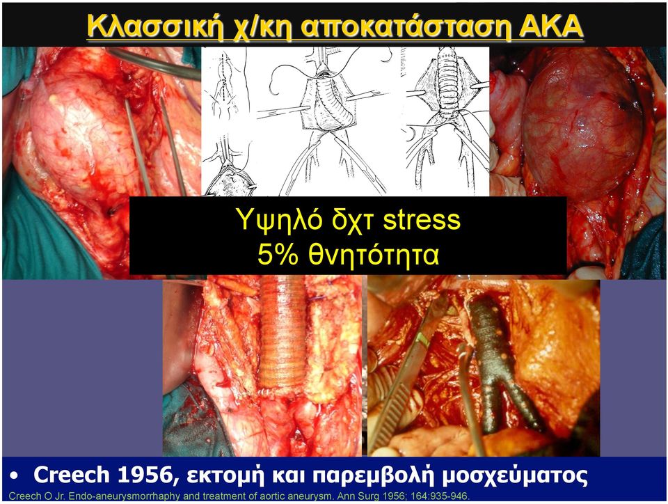 Jr. Endo-aneurysmorrhaphy and treatment of