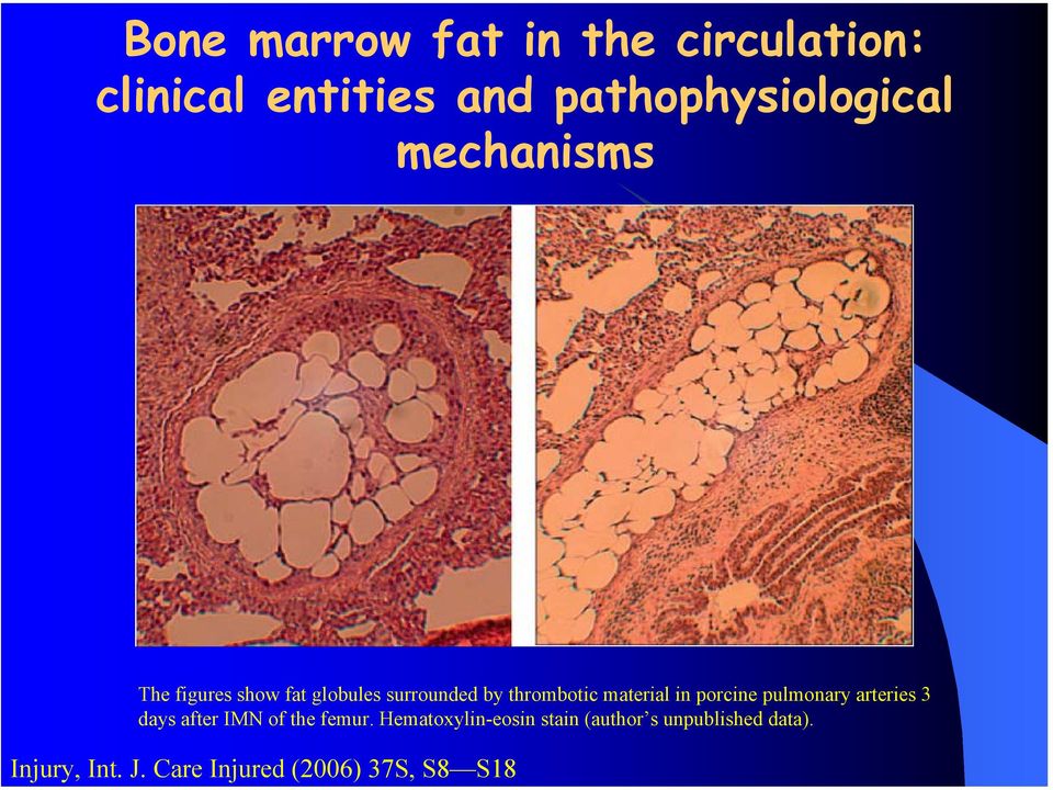 Care Injured (2006) 37S, S8 S18 The figures show fat globules surrounded by